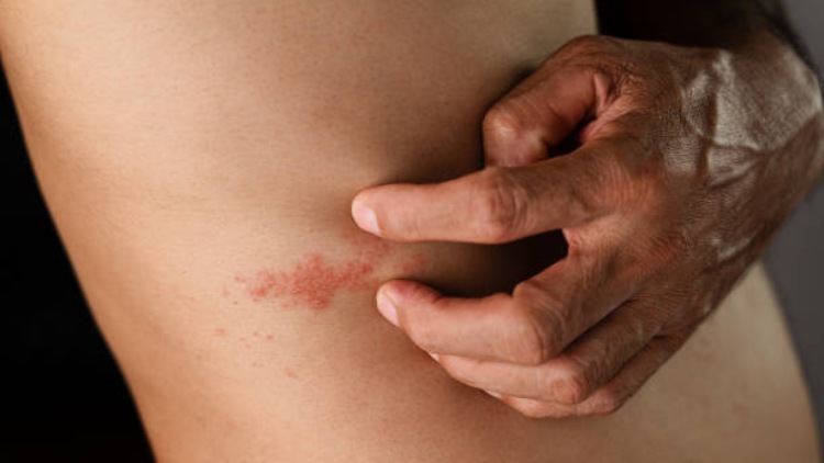 Understanding Shingles: A Guide for Adults 55+