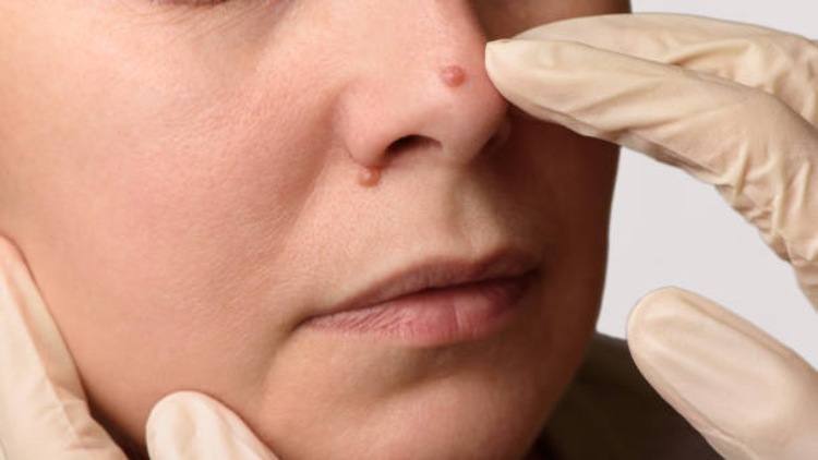 Bid Farewell to Warts: Effective Solutions for Senior Skin Health!